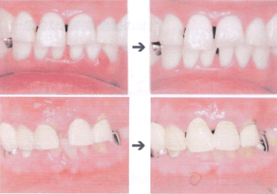 1.歯周内科治療による細菌議の変化