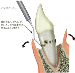 歯周外科は外科的に歯茎を切開
