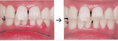 歯周内科治療によるお口の中の変化1