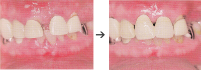 歯周内科治療によるお口の中の変化2