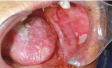 帯状疱疹2