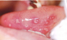 ヘルペス性口内炎の口腔内所見