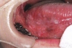 不均一型の舌白板症