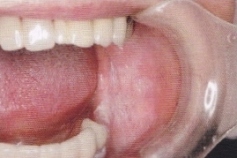 均一型の下顎歯肉・頬粘膜白板症1
