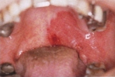 口蓋の紅板症