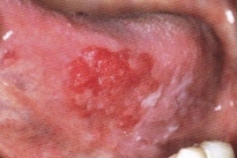 舌の紅板症