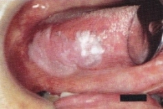初診時の舌白板症