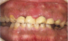 薬物性歯肉増殖症