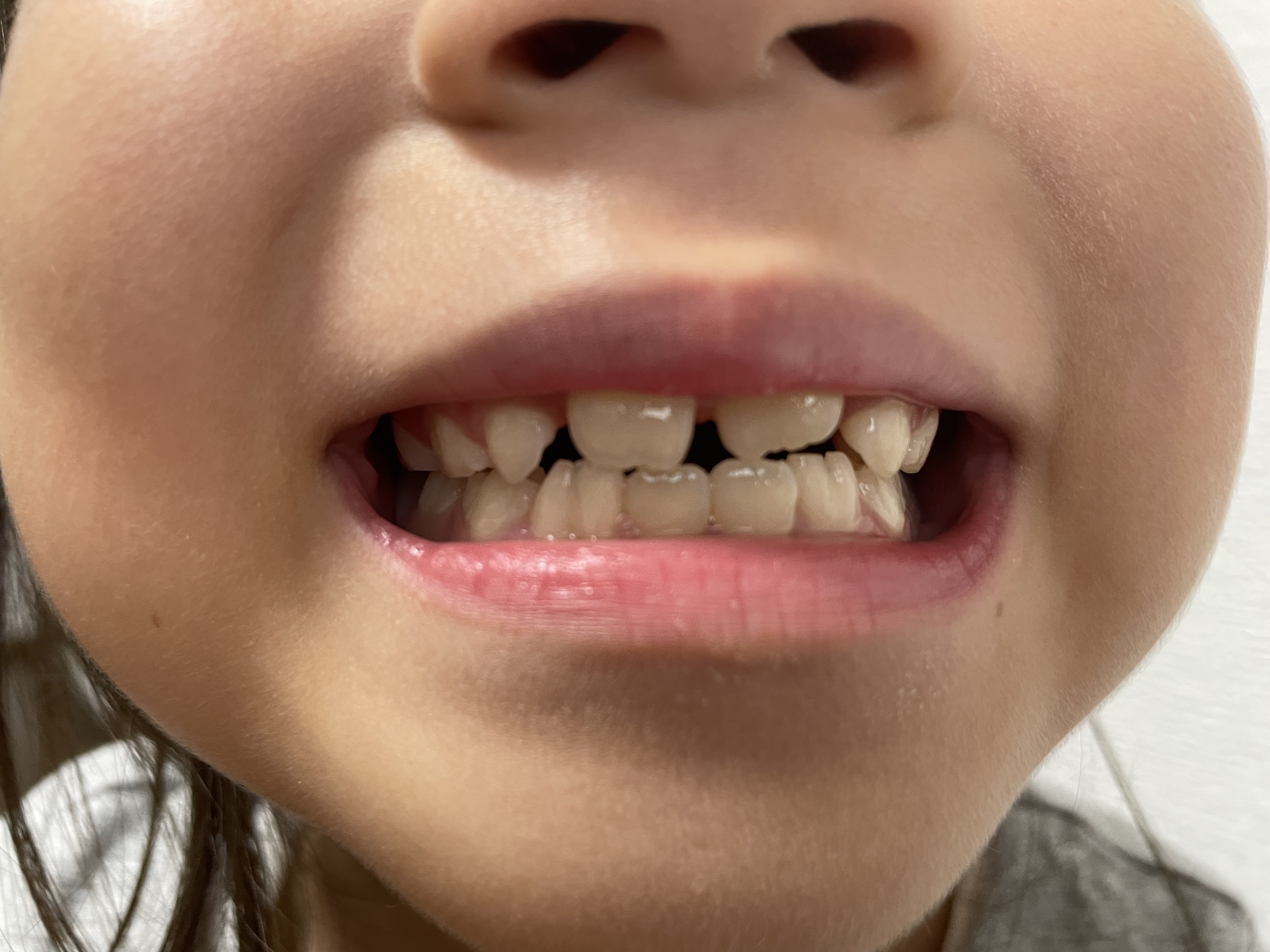 子どもの歯並びと舌の癖