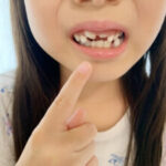 永久歯の前歯について